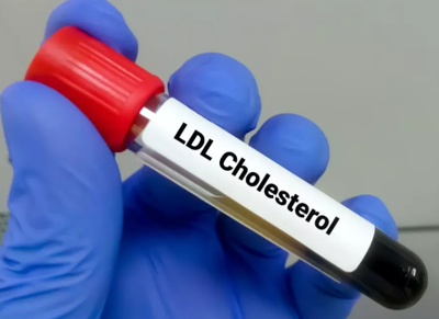 LDL Cholesterol