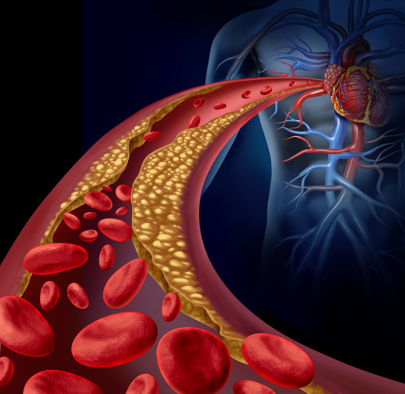 RS7046_sy_artery_atherosclerosis_cl_A26711342_clean_2015_scr (1)